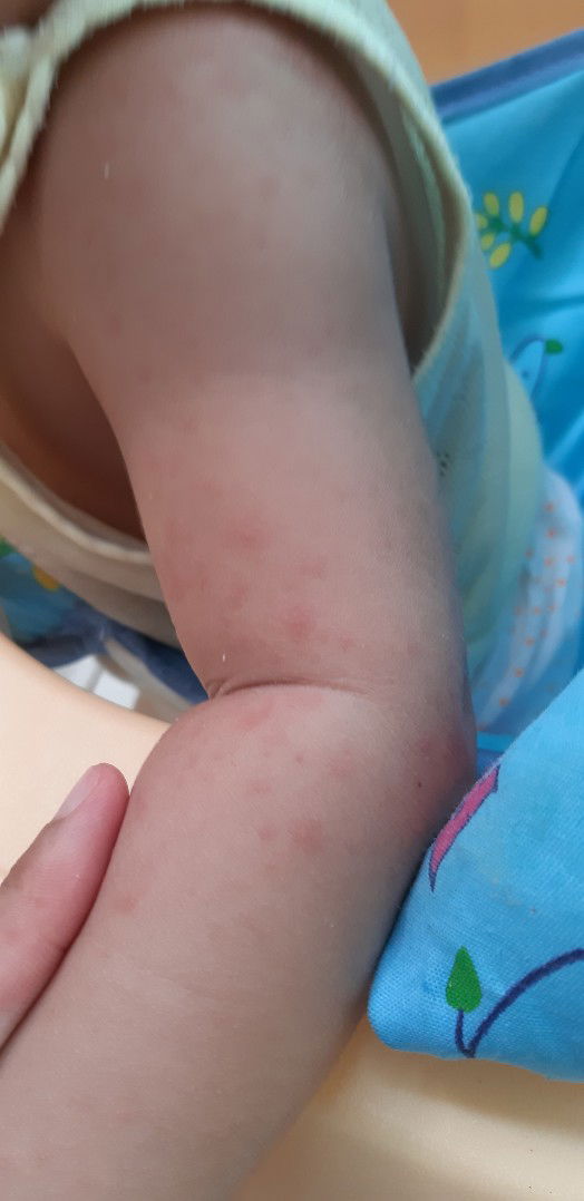 Ruam di Tangan Bayi