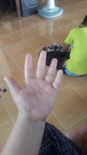อาการบวม