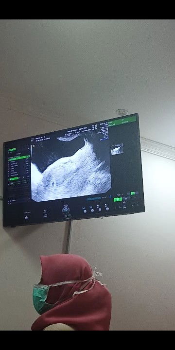 2.5 tahun menunggu ada yang sama dengan saya? belum kelihatan janinnya