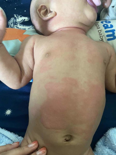 ลูกเป็นผื่น