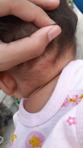 ผื่นขึ้น