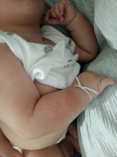 แบบนี้ใช้โรคหัดรึเปล่าคะ