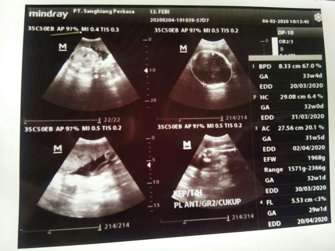 Apakah hasil USG selalu akurat?