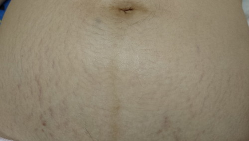 ท้องแตกลาย