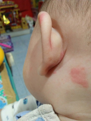 ลูกเป็นผื่น