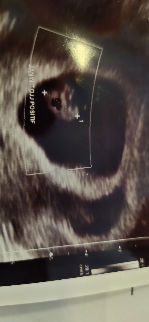 pendarahan subkrionik