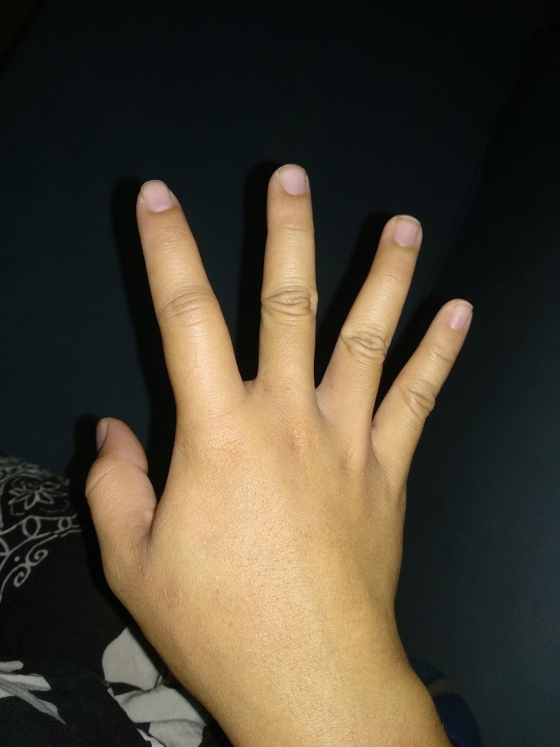 Gatal2 di telapak tangan