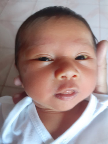 yellowish ng mga mata