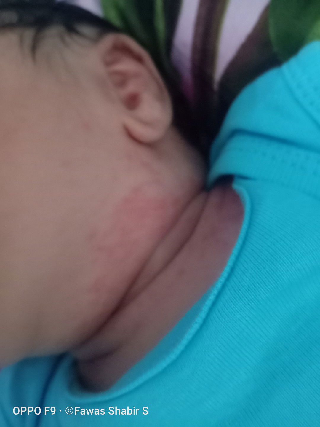 Leher beby bintik dan merah