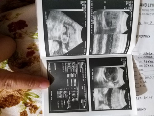 ultrasound