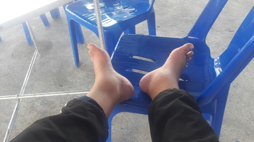 เท้าบวม