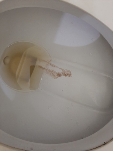 brown fluid discharge