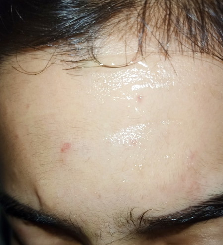 สอบถามแม่ๆตอนท้องมีจุดแดงๆขึ้นตามร่างกายบ้างมั้ย