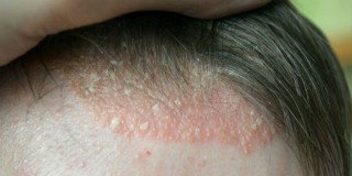 bintik bernanah dikepala dan biang keringat