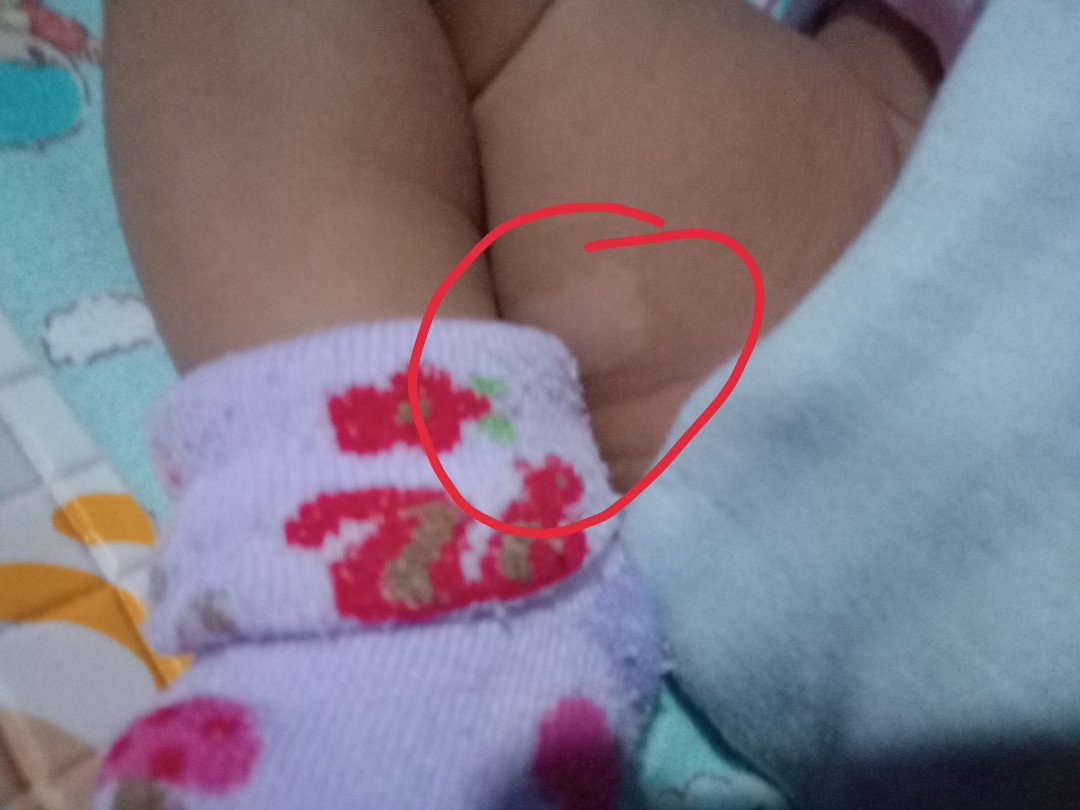 bercak putih pada kulit bayi