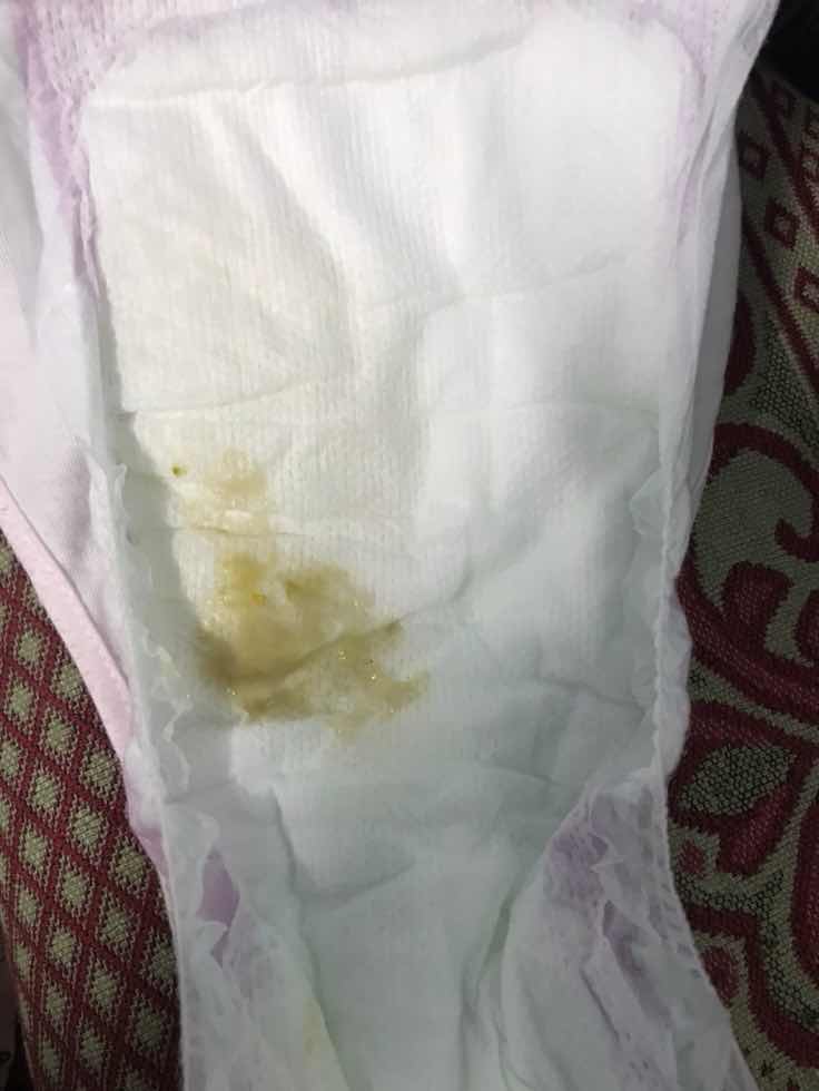 Phân như vậy có bình thường