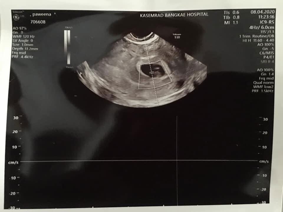 อนุญาติแชร์ประสบการณ์ เลือดออกต้องระวังรีบหาหมอนะคะ