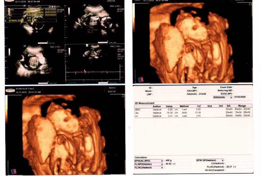 Hasil USG 4d 22weeks