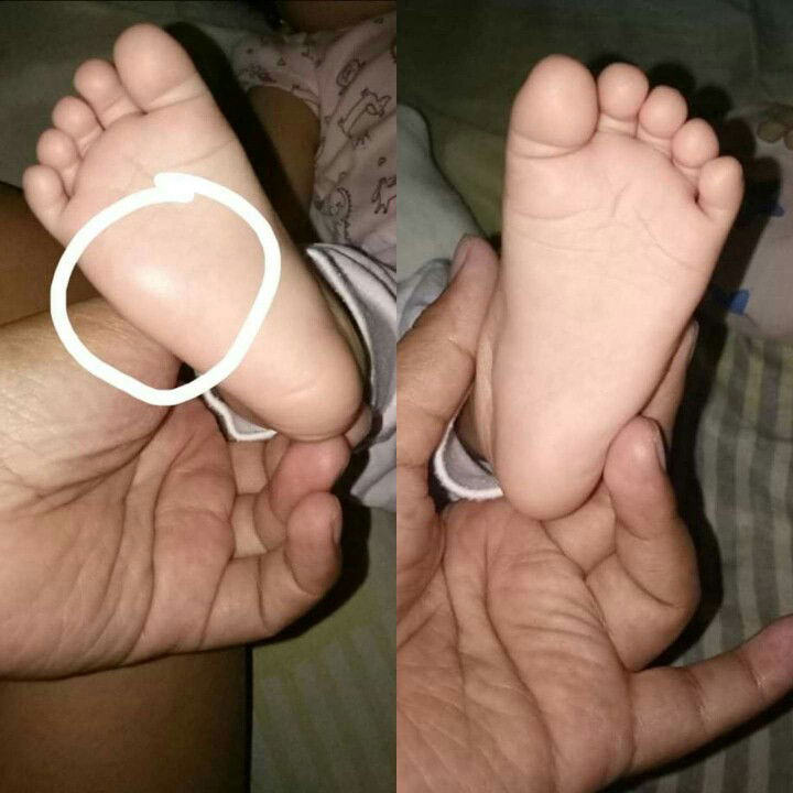 maga sa paa (walang bahid ng marka ng kahit anong kagat ng insekto)