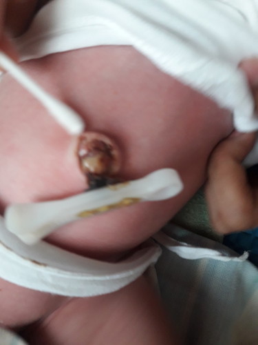 Umbilical Cord ( 18 days old)