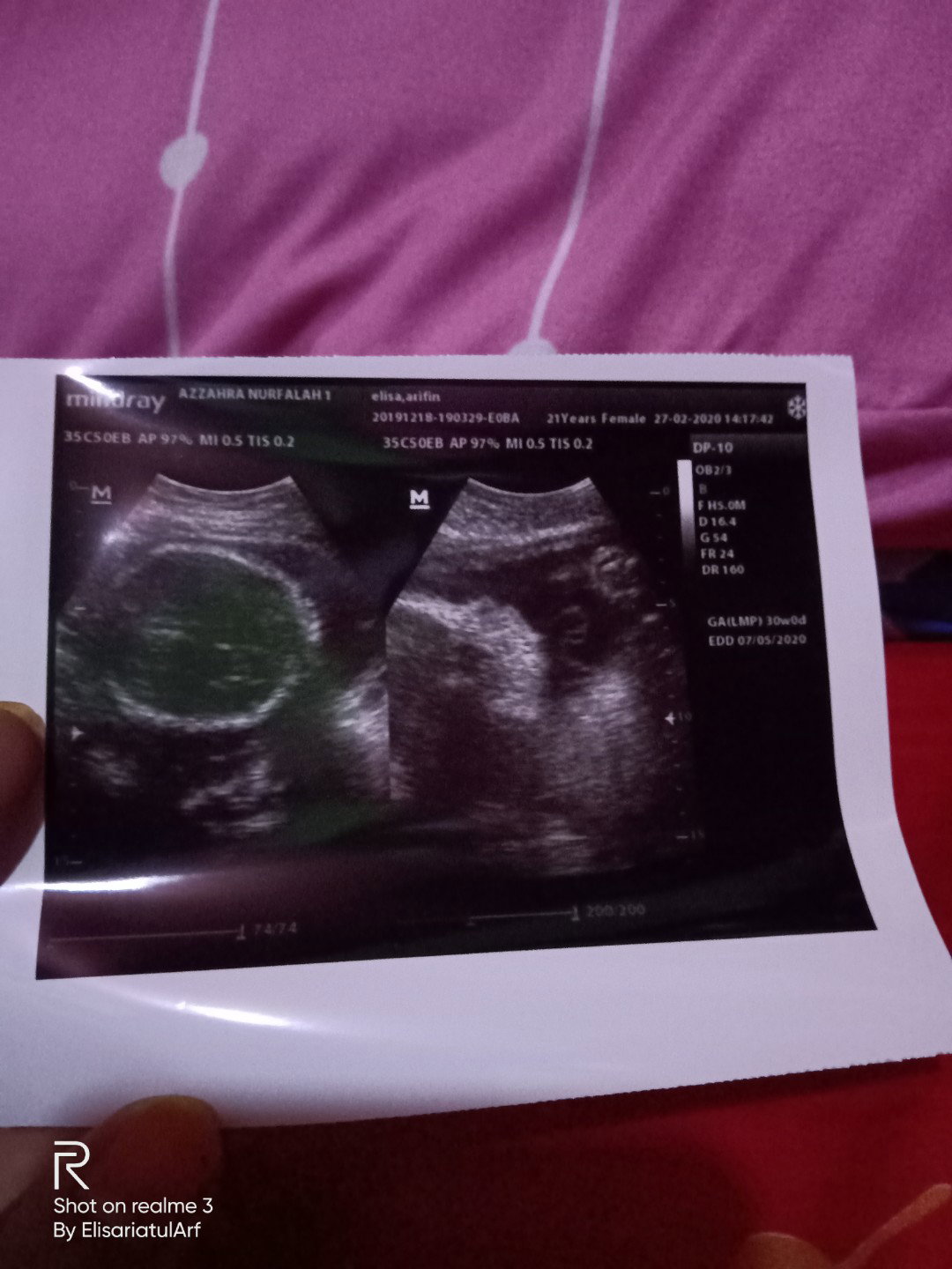 hasil USG