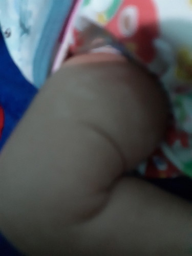 kulit bayi belang