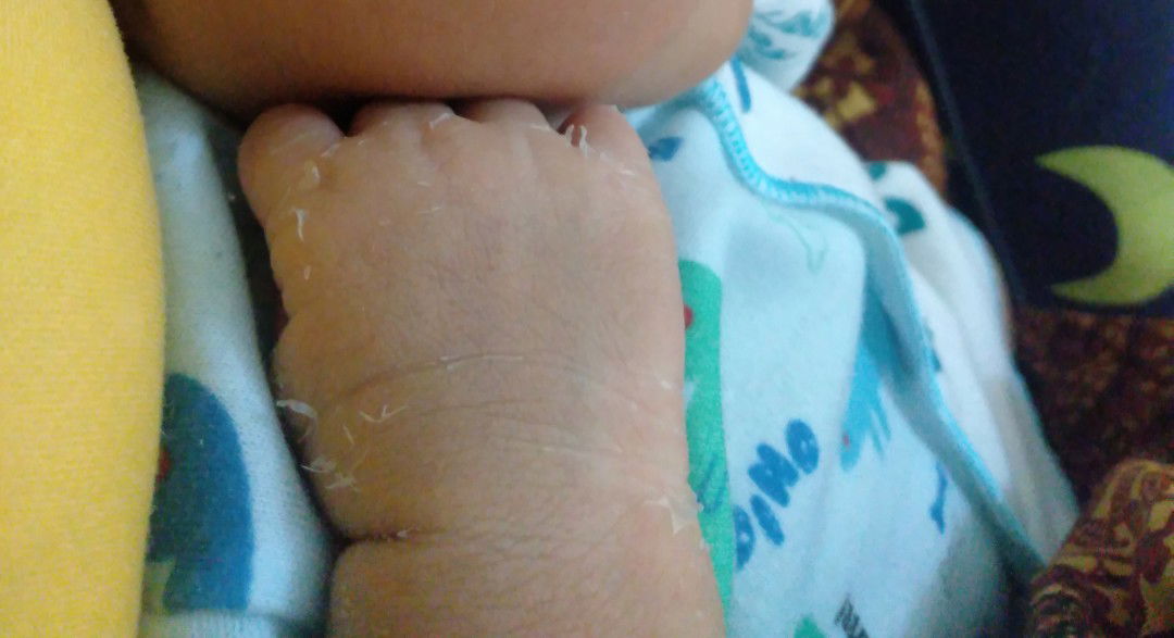 kulit bayi mengelupas