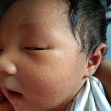 buruntus dan belekan