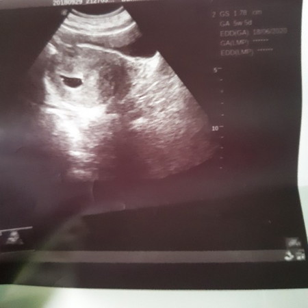 pregnancy