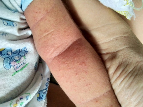 ผดผื่นขึ้นแขนพับ