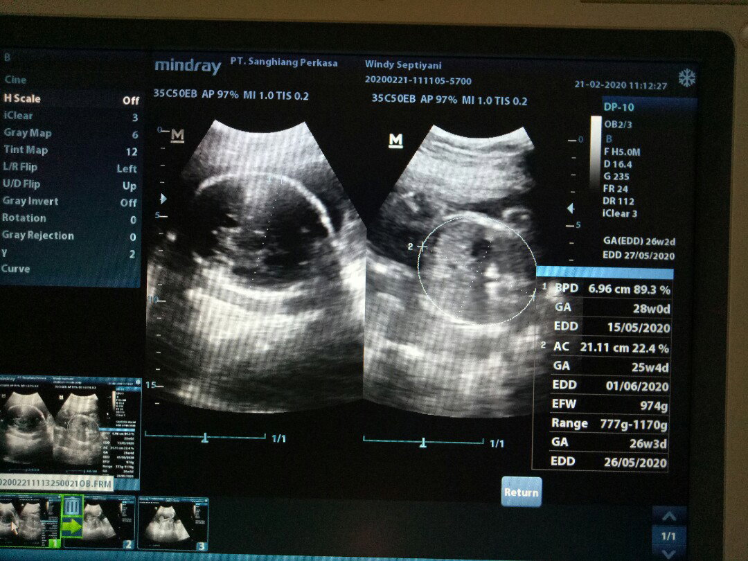 BB bayi