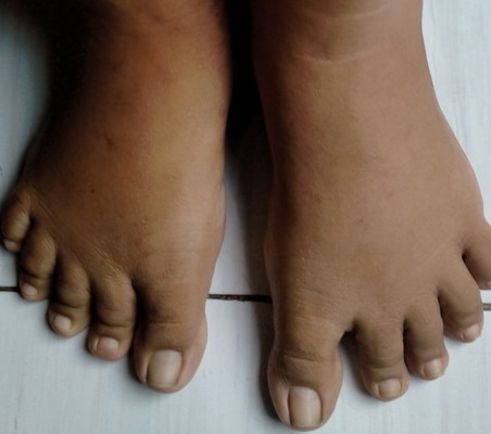 Kaki bengkak. Saat. Hamil 36 wek 1 day