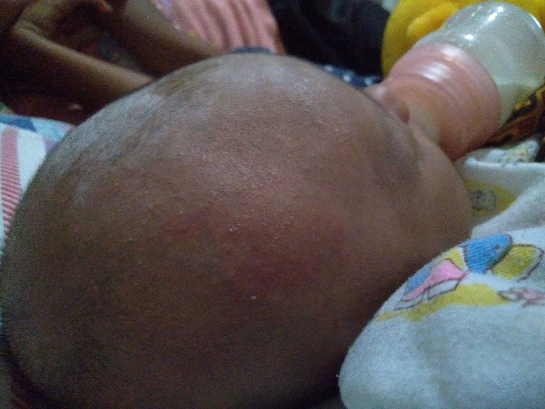 Bintik dikepala?  Biang keringat kah?