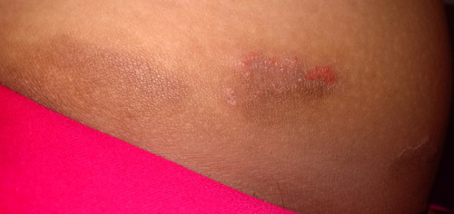 kurap diselangkangan