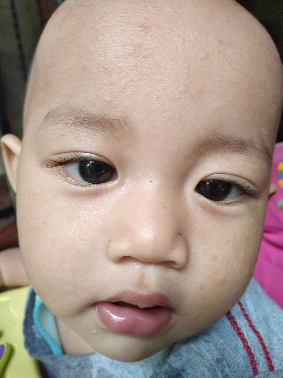 muncul bintik merah di seluruh tubuh