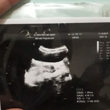 janin lambat berkembang.