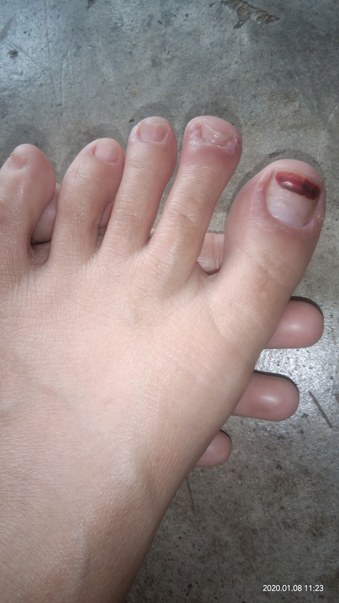 jari kaki memar merah.