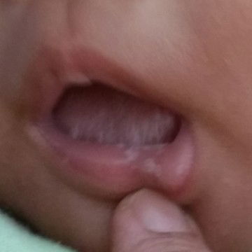 Bintik Putih Di Lidah N Bibir