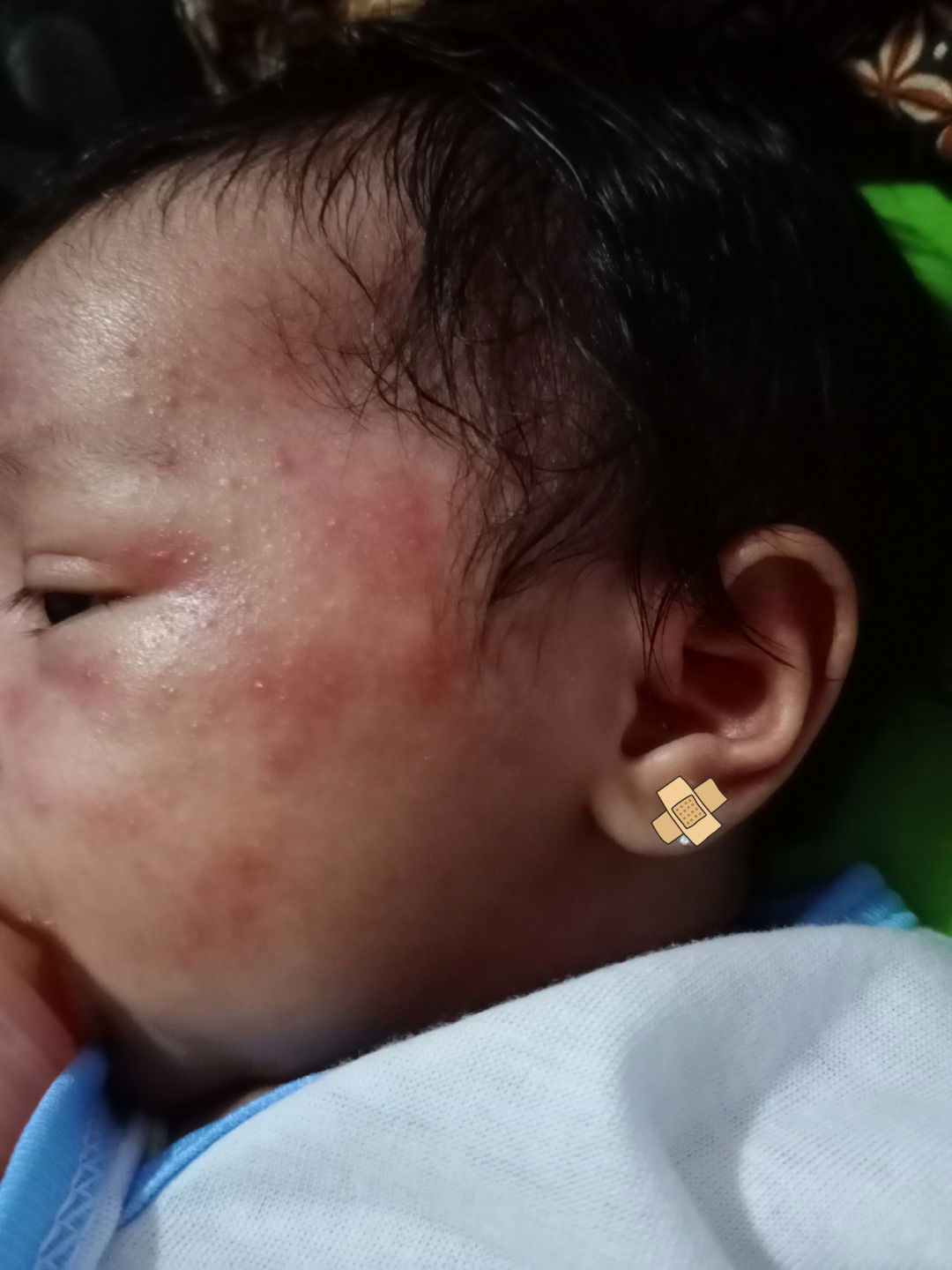 bintik merah di pipi