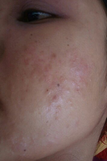 Wajah bruntusan merah-merah dan gatal