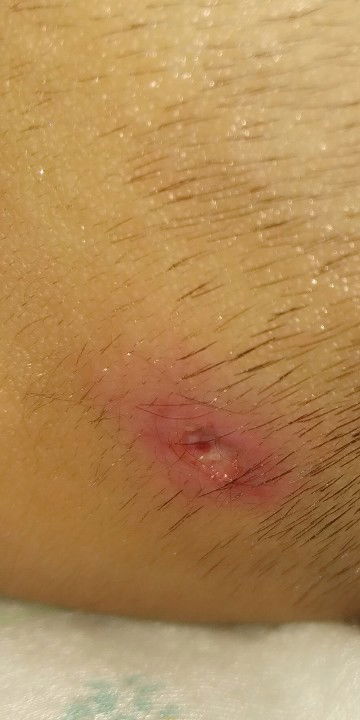 luka karena biang keringat