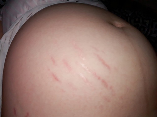 Ano po kayang mabisang Remedy for Stretch Mark?