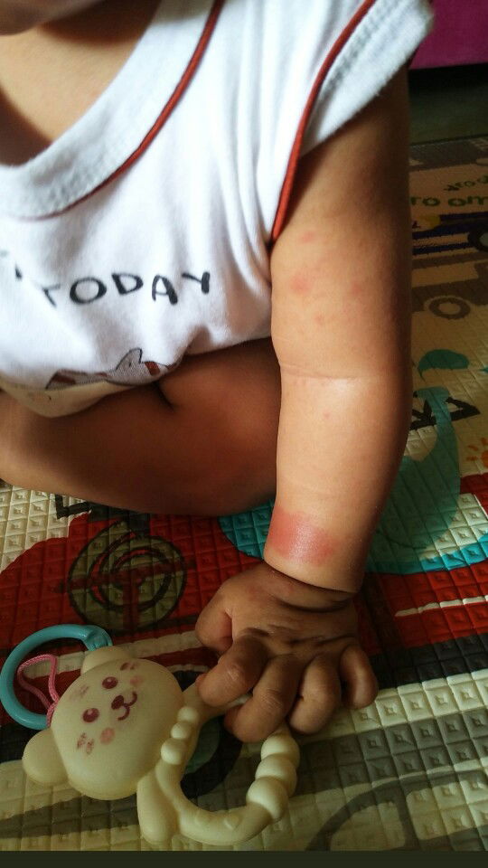 kulit lengan merah merah