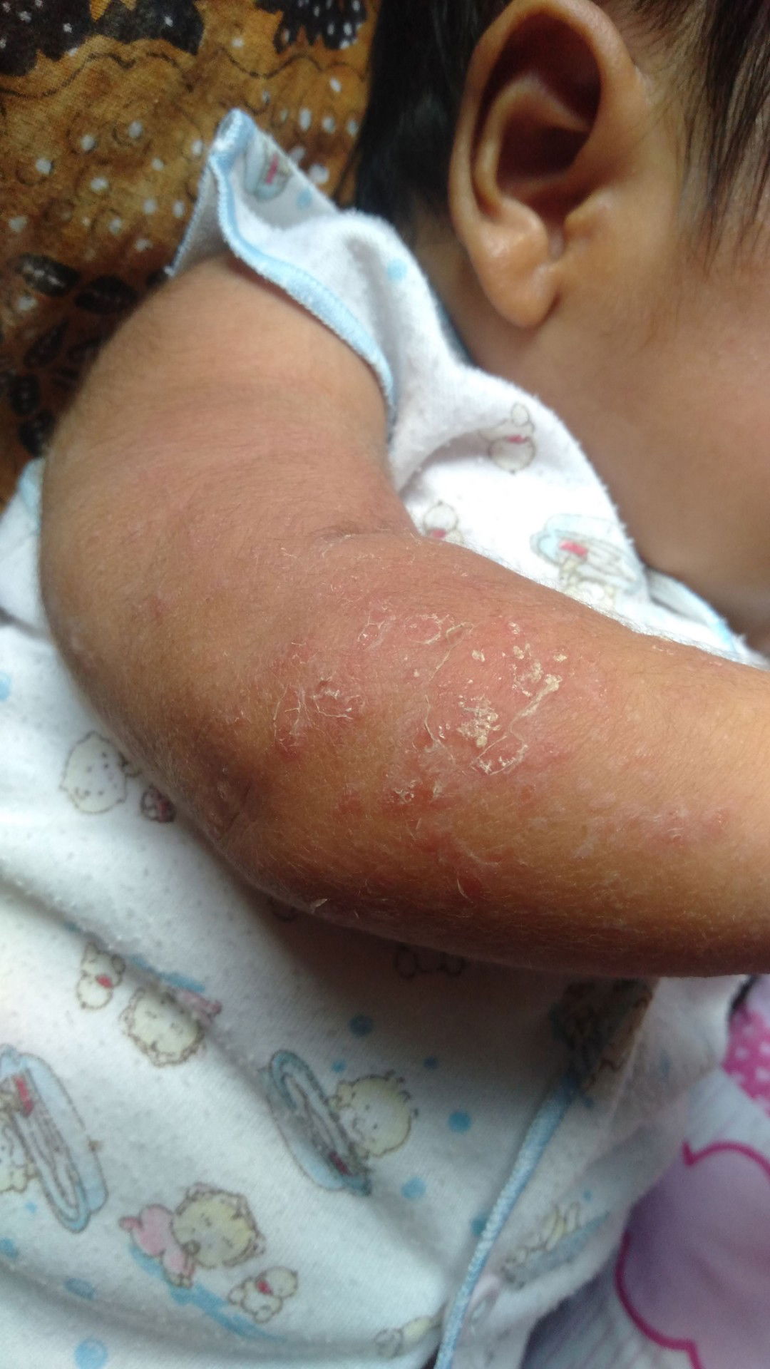 mengatasi herpes pada bayi