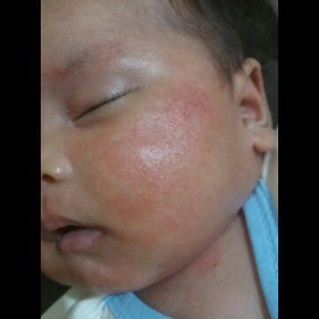 ruam pipi terkena air asi
