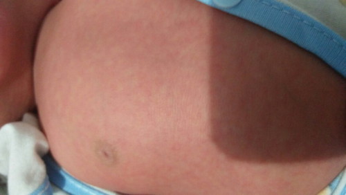 bayiku umur 28 hari..  di badanya ada bintik2.. merah itu kenapa ya.. ad yang alamin sama..? a.