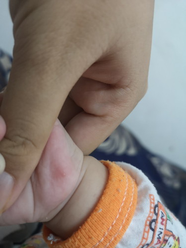 ตุ่มเหมือนสิวที่ฝ้ามือ