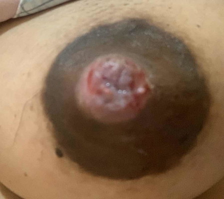 Inverted nipple