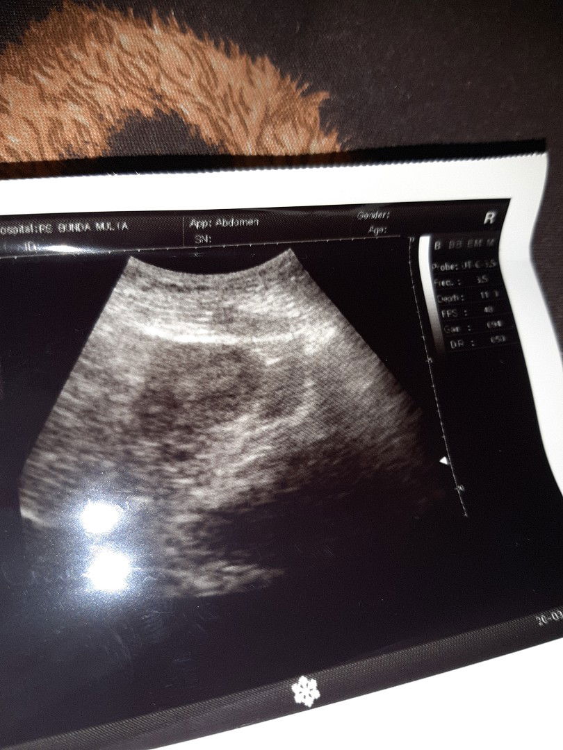 Test pack negatif Telat 15 hari USG