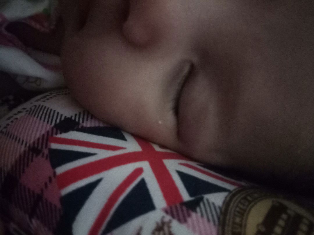 ต้องการสอบถามเกี่ยวกับตุ่มเม็ดสีขาวขุ่น แข็งที่ขึ้นบริเวณหน้าลูกคะ